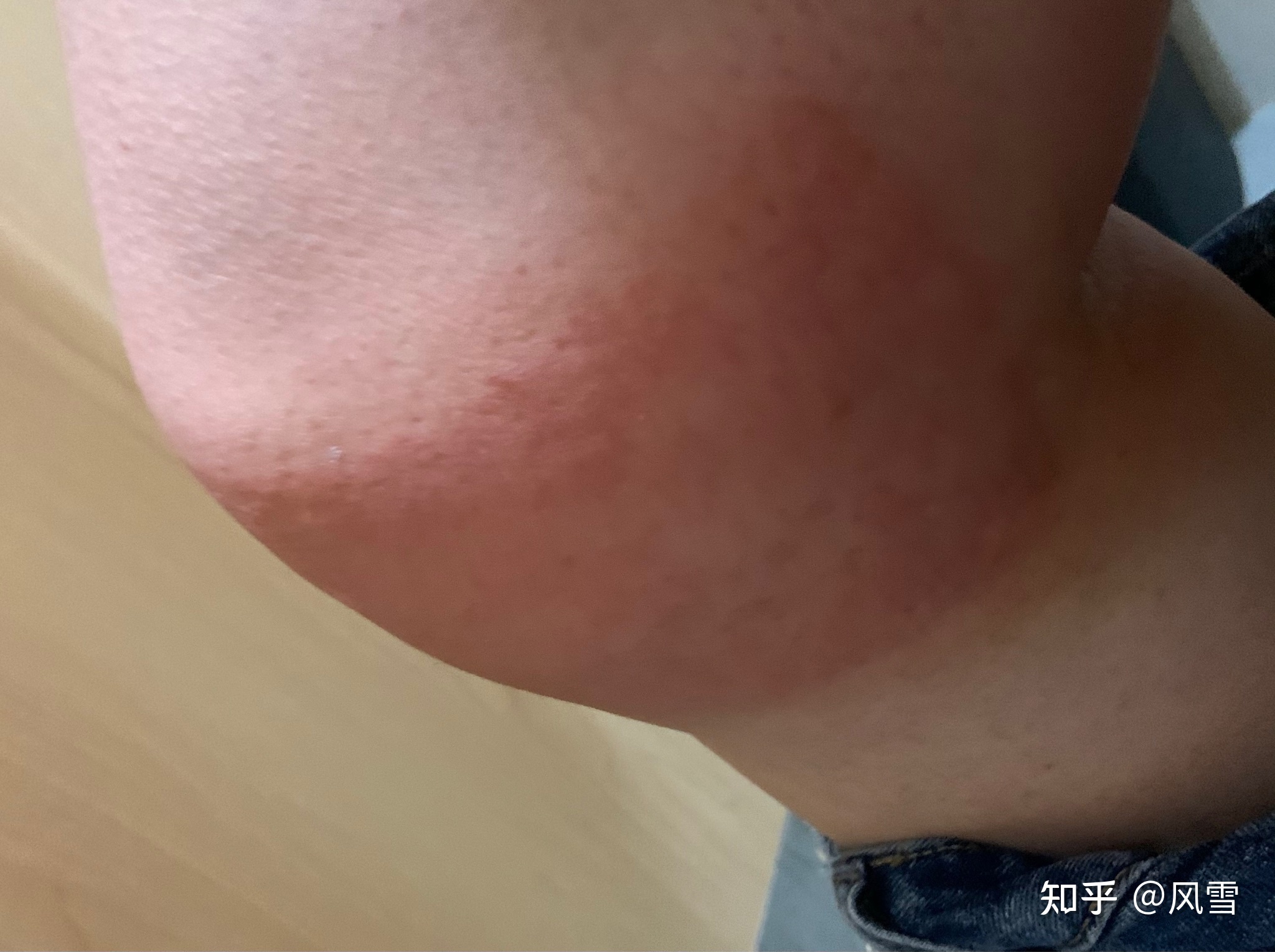 1、貼膏藥過敏癢紅腫怎么辦？