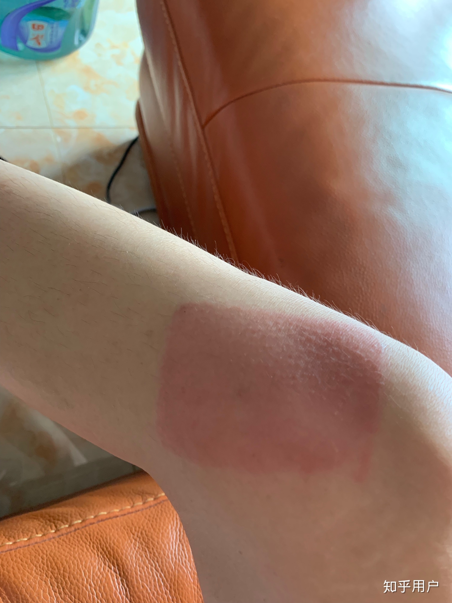 2、貼膏藥的地方有很多紅疙瘩，好不好？